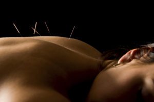 Synergy Chiropractic of Houston Medical Acupuncture and Dry Needling