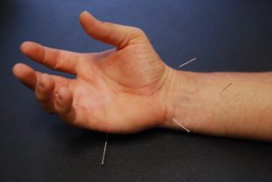 Dry Needling with Hand Pain