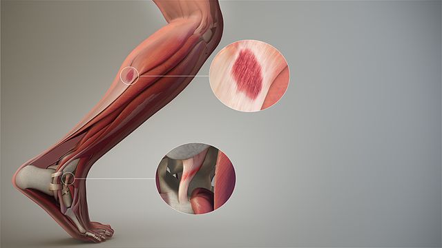 How Are Soft Tissue Injuries Diagnosed?