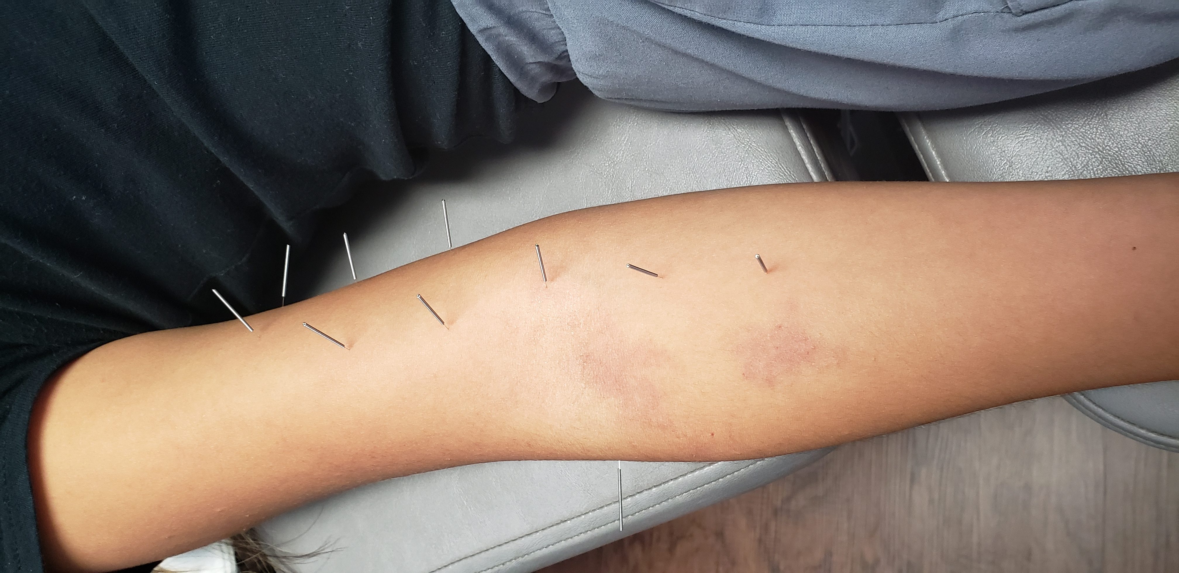 5 Dry Needling Benefits For Quick Pain Relief - Synergy Chiropractic of  Houston